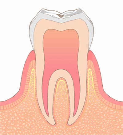 C0.エナメル質表面のむし歯