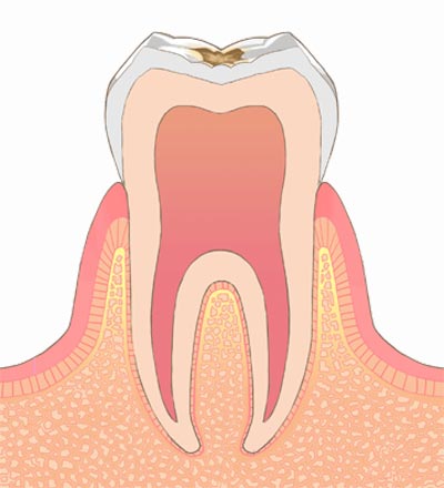 C1.エナメル質内のむし歯で象牙質までは達していないもの