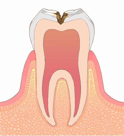C2.象牙質まで進行したむし歯