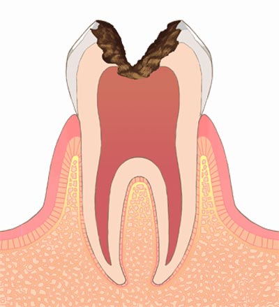C3.歯髄まで進行したむし歯