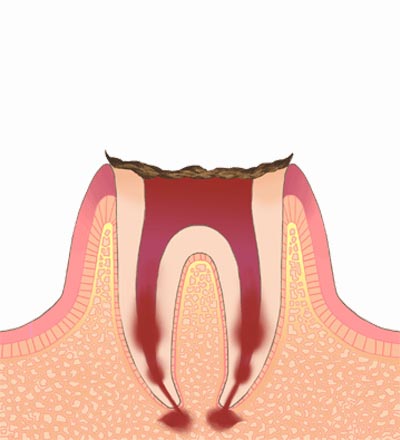 C4.むし歯で歯のほとんどがなくなってしまい歯の根しか残ってない状態