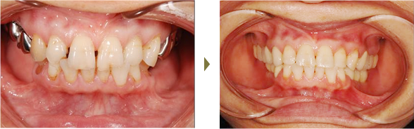 インプラント治療症例 Case2