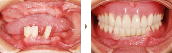 インプラント治療症例 Case4 インプラントデンチャー