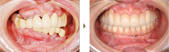 インプラント治療症例 Case6 オールオン４・オールオン６