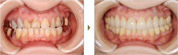 セラミック治療治療症例 Case1