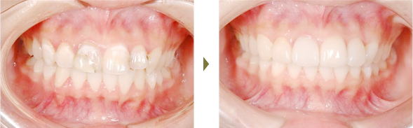 セラミック治療治療症例 Case2