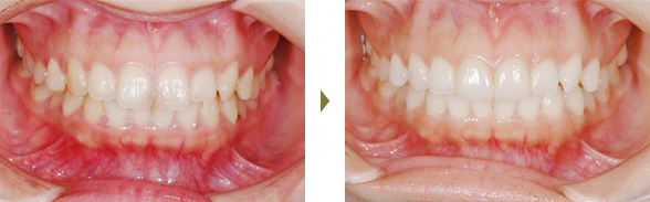 セラミック治療治療症例 Case3