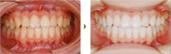 ホワイトニング治療症例 Case2