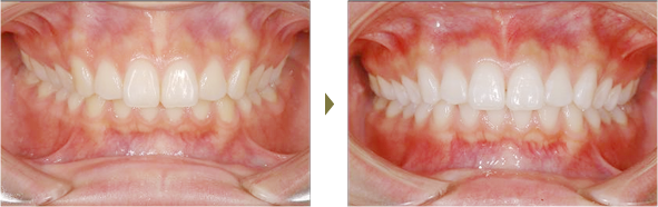 歯列矯正症例 case1