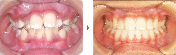 歯列矯正症例 case2