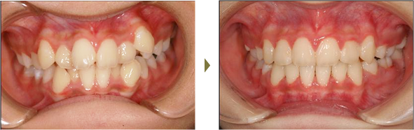 歯列矯正症例 case3