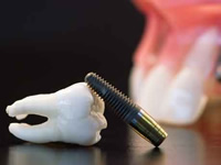 インプラントと歯茎の模型