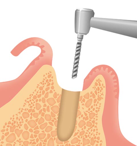 インプラントの埋め込み