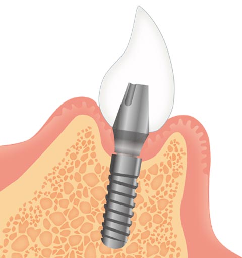 インプラント装着のイラスト