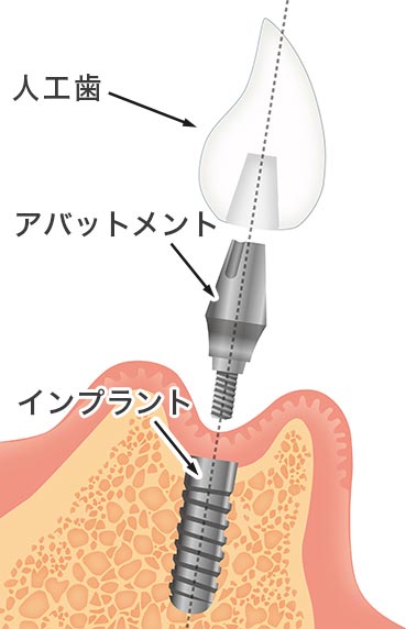 インプラント 治療の流れ オールオン4 デメリット 大野城市の歯医者ミント歯科クリニック