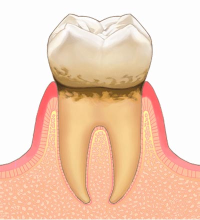 軽度歯周病