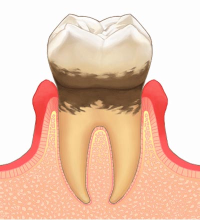 中度歯周病