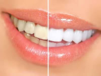 ホワイトニングの効果比較のための女性の口元：左側が治療前、右側が治療後